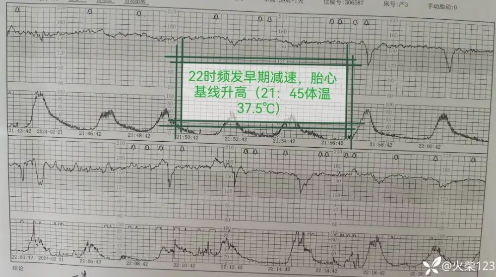 产妇发热，胎心基线变异，千万别忽略这个关键因素！