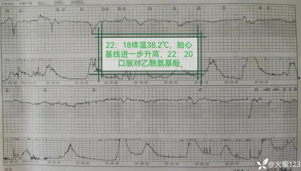 产妇发热，胎心基线变异，千万别忽略这个关键因素！