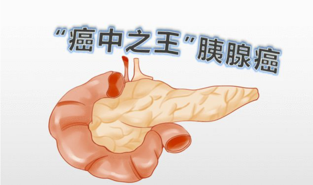 人体胰腺到底在哪？胰腺癌怎么回事？深入解读，全面防治