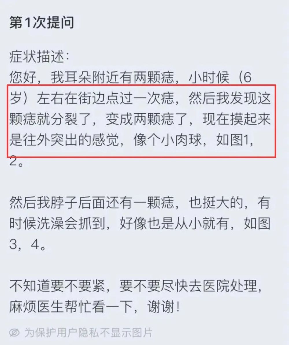 担心痣变成恶性黑色素瘤？长在 3 个地方要注意