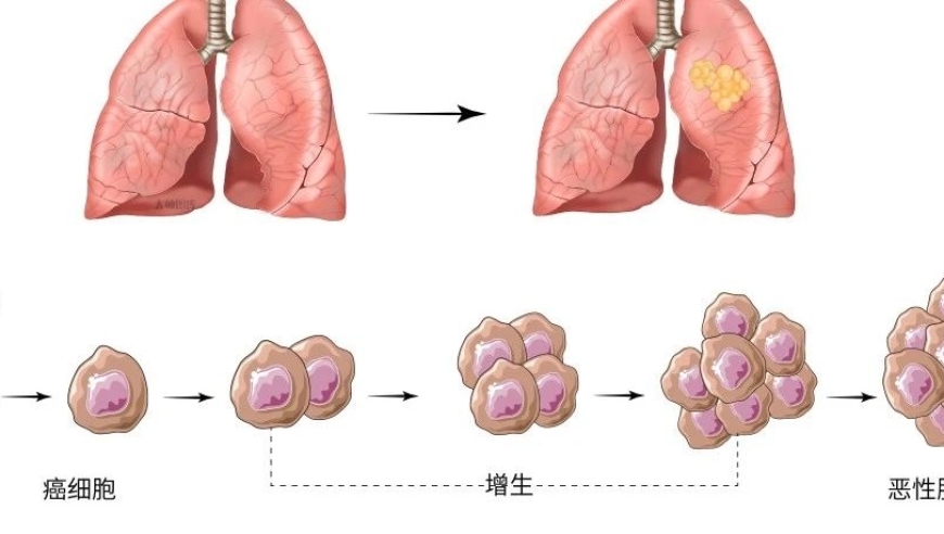 大部分美国癌症患者会选择放射治疗。一句话即可。