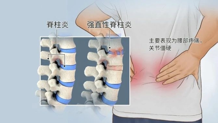 强直性脊柱炎，深入了解并应对策略。