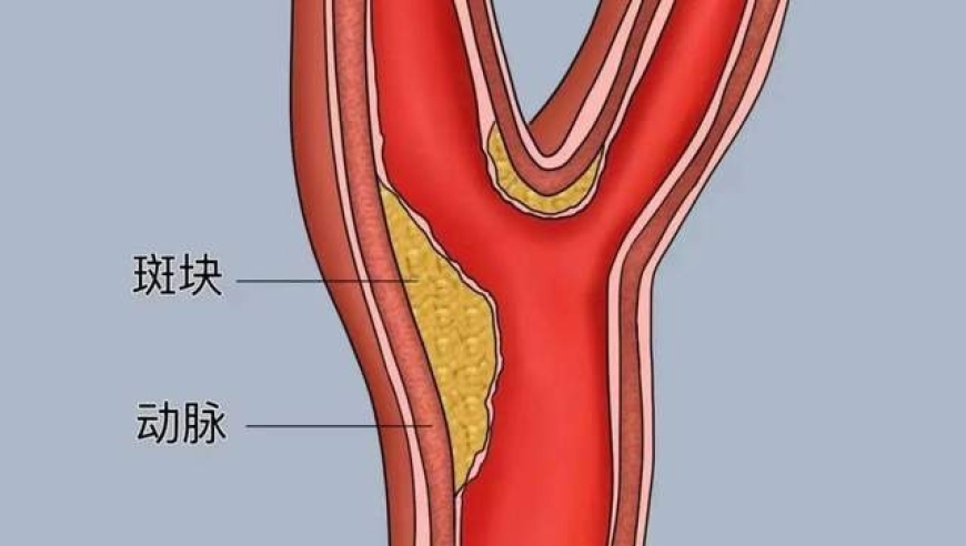 颈部问题不容忽视，颈动脉斑块！了解其形成及检测方式。