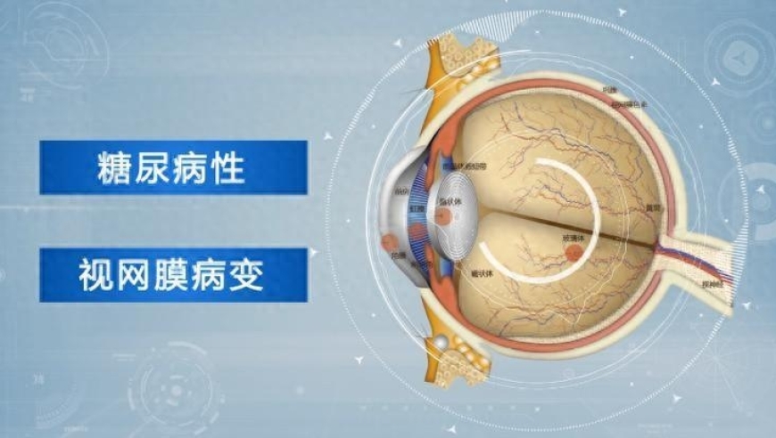 糖尿病视网膜病变原因是什么？如果出现这些异常迹象，请提前采取措施保护视力。