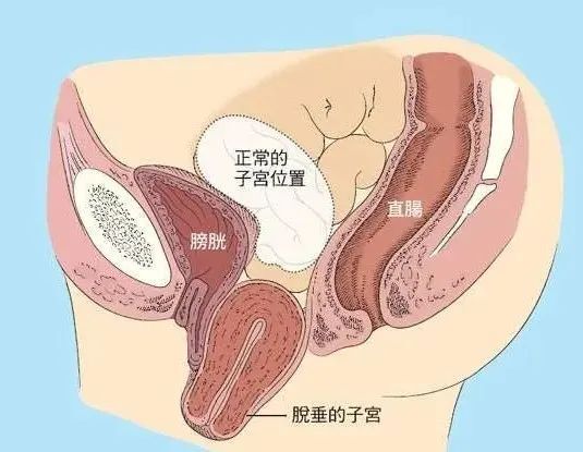 "全面解析：经阴子宫全切除与阴道前后壁修补术的视觉展示及操作流程详解——图解剖析（详解版）"