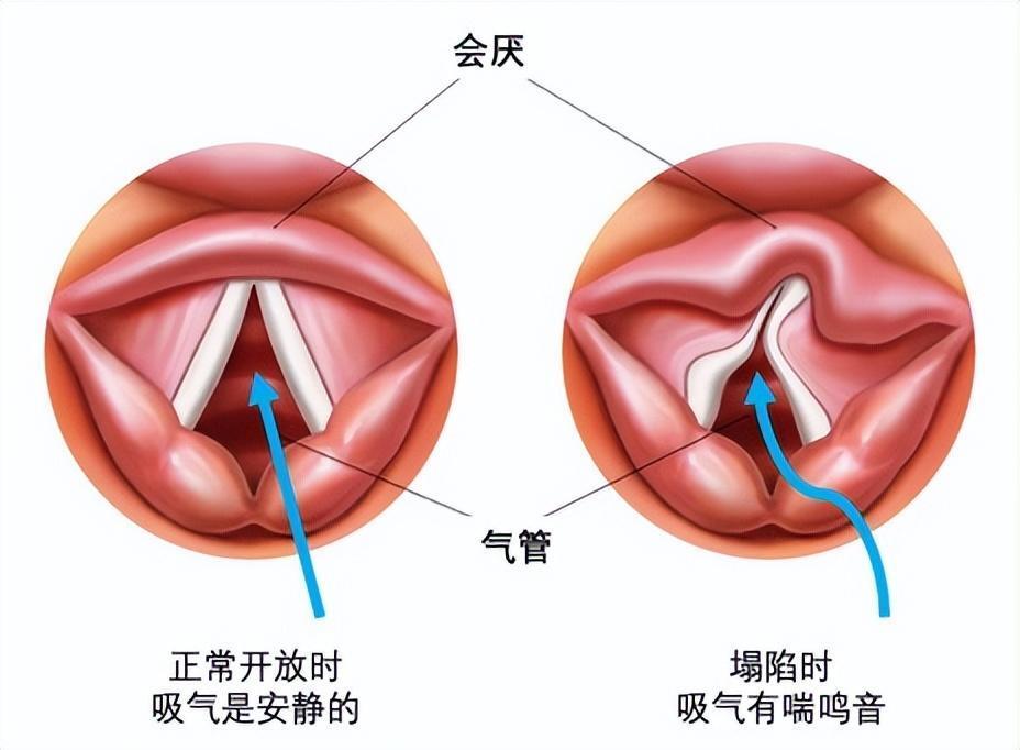 "警惕宝宝喉部呼噜声音！可能并非只因痰，有可能是这4种常见疾病引致，需及时就医排查"

1. "探索宝宝喉咙异响：呼噜≠痰，了解其潜在健康隐患"
2. "宝宝喉咙呼吸不畅？别误以为只是痰液问题，也可能患病"
3. "揭秘宝宝长期嗓音嘶哑的真相：呼噜并不全因痰，多提示病情需留意"
4. "误认呼噜为仅因痰的原因？家长需警惕潜在的宝宝健康危机"
5. "宝宝吸气呼噜？可能是这4种病因并有针对性治疗"
6. "看似无害的呼噜声背后隐藏的是疾病的信号，切勿忽视排查"
7. "宝宝呼吸困难，可能是误将呼噜理解为积痰所致？需引起重视"
8. "挖掘深层原因：理解宝宝呼噜声音背后的潜在健康威胁"
9. "独特呼噜症表现：确认孩子是否真的患上了呼噜问题需要考虑多种因素"
10. "倾听宝宝特殊鸣叫：警惕不清晰的呼噜声，父母应小心这是疾病的先兆"