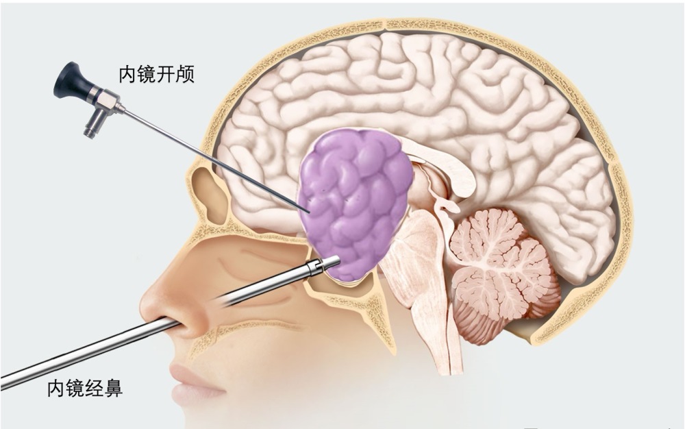 "男性大脑内巨型垂体瘤肆虐，两月之内从轻盈壮硕到精瘦如柴：揭秘神秘病症的惊悚演变过程及可能的治疗与预后预测"