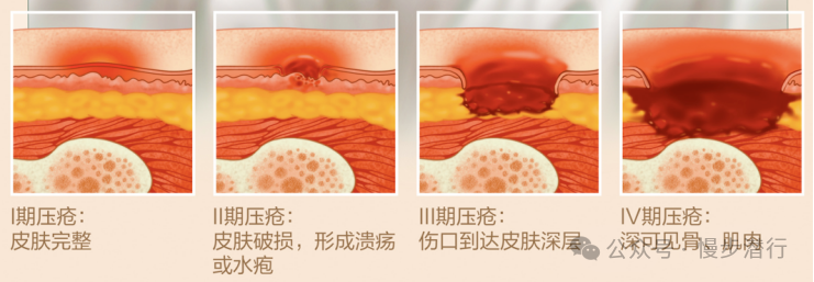 "深度解读：从压疮分级到预防：一个全面指南及策略探讨"