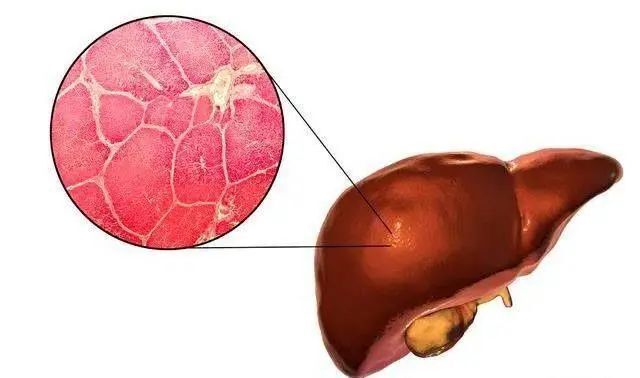 "专家深度解析：避免脂肪肝，全方位掌握远离肝脏困扰的秘诀！"