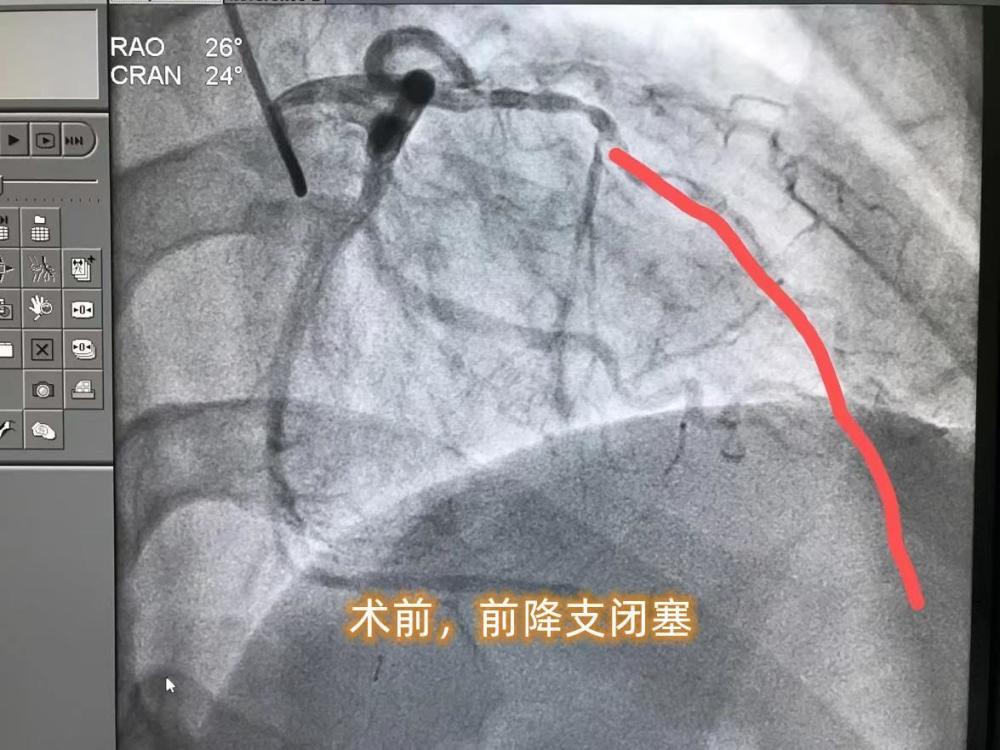 "原以为冷静与理智的青少年，在38岁却经历了心脏与肺部的双重惊吓：从高危吸烟到未及时就医的心肌梗死，背后的真相令人深思——是无知，还是无畏？"