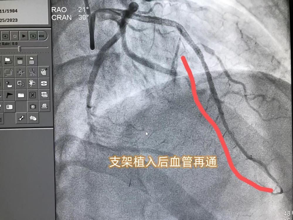 "原以为冷静与理智的青少年，在38岁却经历了心脏与肺部的双重惊吓：从高危吸烟到未及时就医的心肌梗死，背后的真相令人深思——是无知，还是无畏？"