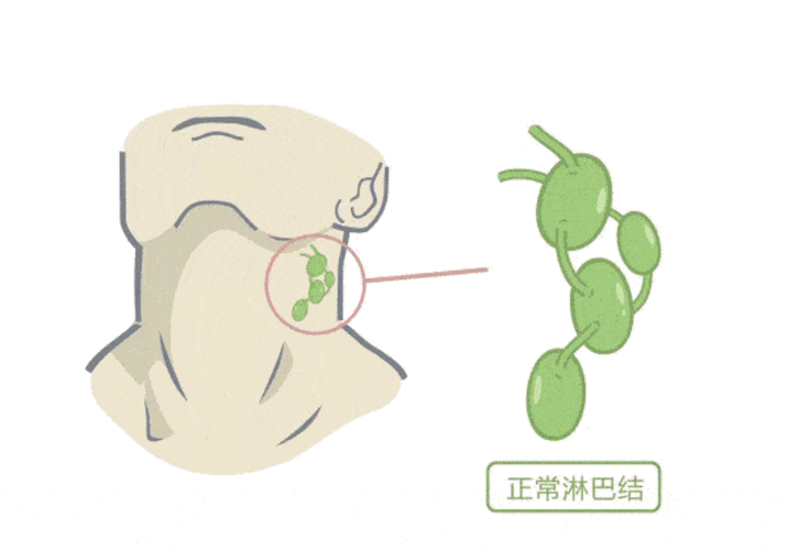 "精准识破：细察小淋巴结预警，掌握防淋巴结炎秘籍，避免重大疾病隐患！"