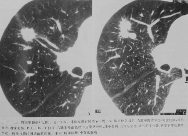 "探讨毛刺肺结节：与肺癌关系及如何理解肺部感染可能引发这一现象"

1. "毛刺肺结节——肺部感染：辨识病因与排除误诊"
2. "解读肺部毛刺：疫情冲击下的谣言与真伪"
3. "为何毛刺肺结节会频繁出现于疫情期间？探析病原机制"
4. "肺部毛刺：结合感染性疾病解读肺部结节形成的关键因素"
5. "毛刺肺结节与抗生素滥用：是否存在潜在因果关系？"
6. "毛刺肺结节之谜：探究其背后与肺部感染的关系"
7. "肺部感染与毛刺结节：不同疾病背景下两者间可能存在微妙联系"
8. "毛刺结节症：从初次发现到后果，该过程中的医学知识详解"
9. "毛刺肺结节疑虑：解释不典型病例与原因识别的重要性"
10. "肺部毛刺与纤维化：交织着临床疑问与科研洞察的肺结节解读"