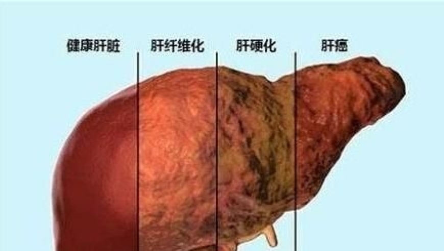 揭开乙肝五项新面纱：阳性并非坏事，恭喜你拥有了健康的新标志！