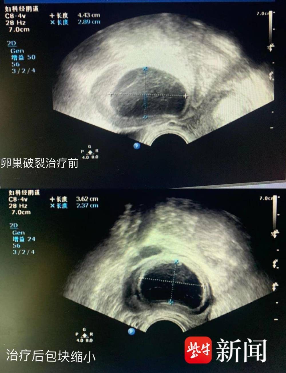 "可怕的是：如果在24岁时，我因卵巢破裂而痛苦不堪，我该如何应对？"