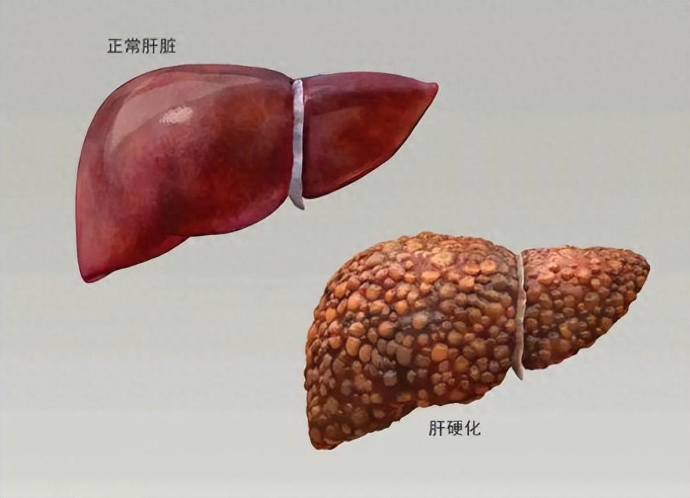 "详解肝硬化的病因与防范措施：从生活点滴抓起"