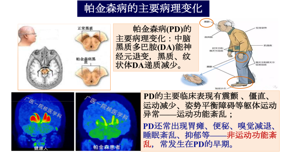 "帕金森病并非唯一神经性脑疾病的早期预警标志，肠胃功能紊乱可能引发该病症。"