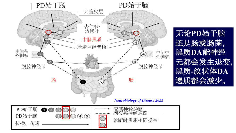 "帕金森病并非唯一神经性脑疾病的早期预警标志，肠胃功能紊乱可能引发该病症。"