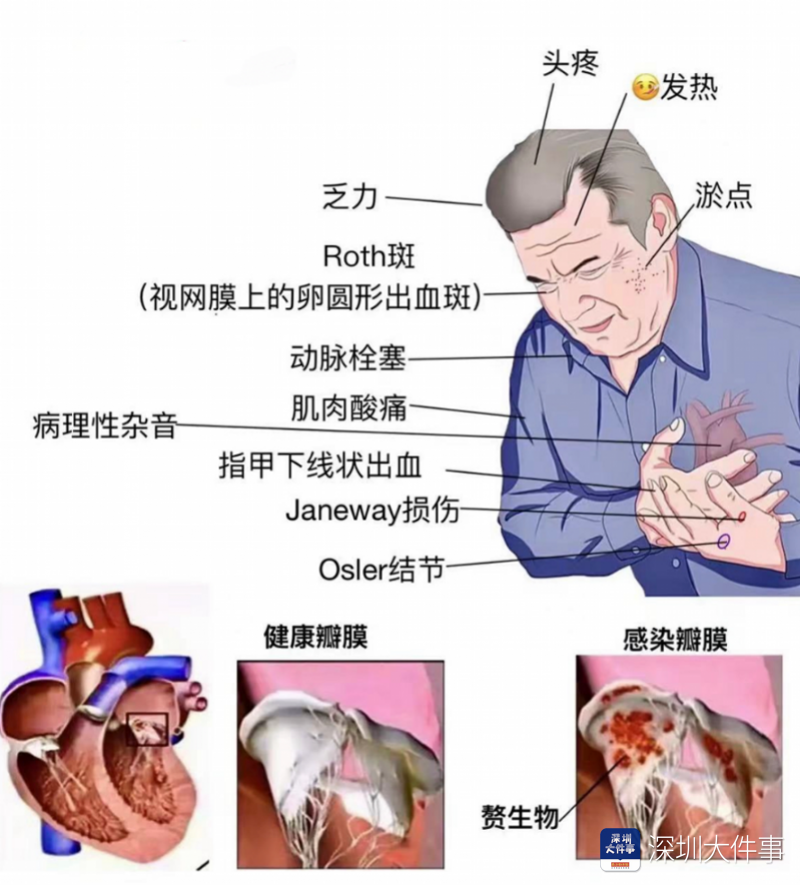 "深圳男子持续发热，心脏险些丧命！细菌感染引发严重后果"