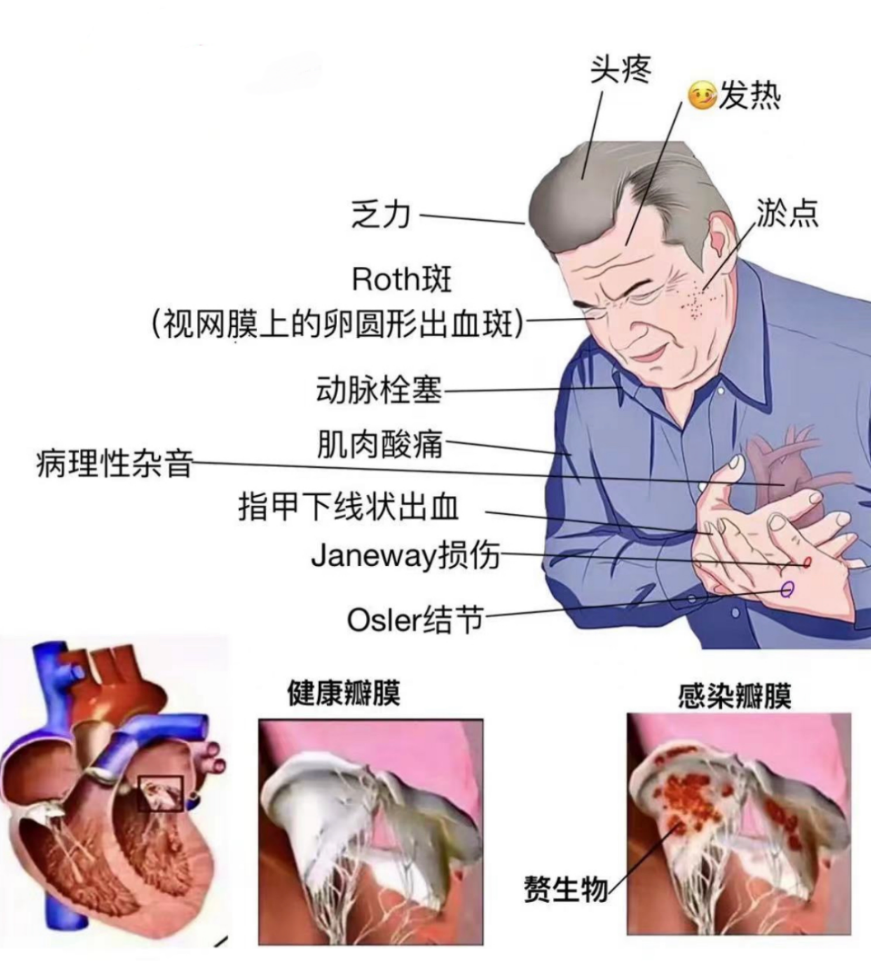 "一位41岁的程序员，因为‘普通感冒’险些丧命！专家提醒：如果你也有这些症状，快去看看吧！"