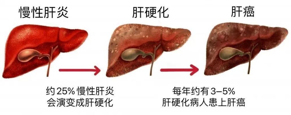 "深度剖析：慢性乙肝的四个关键发展期"