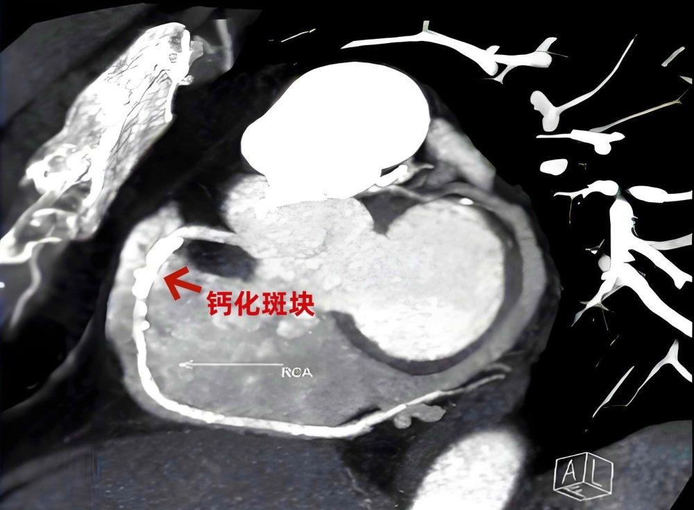 "CT技术发现心脏病隐患，结果大相径庭：为什么我们忽略了它的存在？"