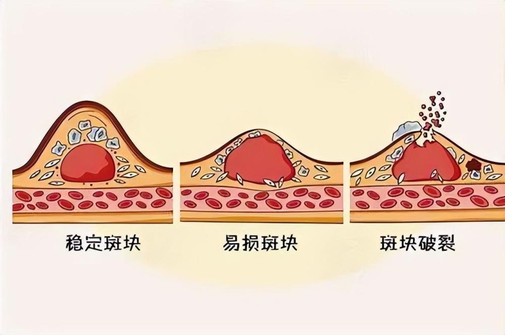 "警惕斑块，你的血液在悄然波动：识别和处理健康的网络世界"