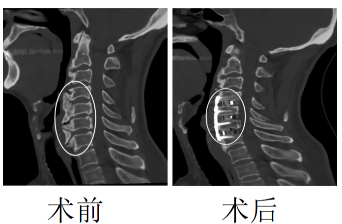 "网路挑战！九旬老者因颈椎韧带钙化压迫食道被迫手术切除"