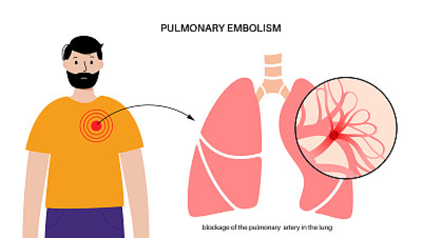 南京一男子床上支小桌子办公一夜猝死，警惕肺栓塞风险！