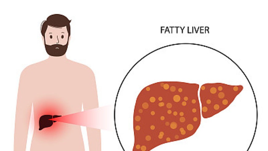 《脂肝靶向药》在美国 FDA 准备进行批准！脂肪肝诊治将迎来空前热潮