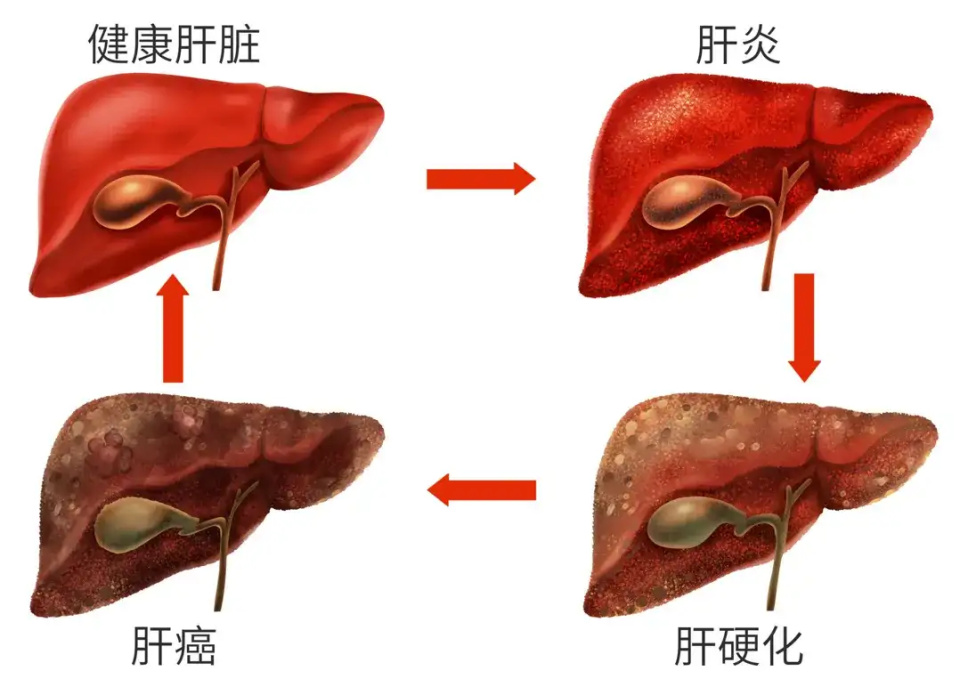 "《脂肝靶向药》在美国 FDA 准备进行批准！脂肪肝诊治将迎来空前热潮"