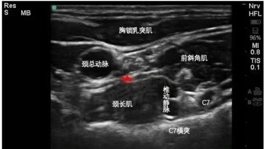 鼻炎治疗需要因人而异：有鼻炎，针灸是否靠谱？