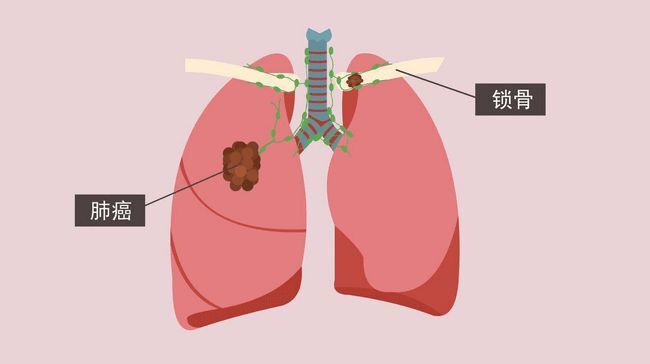 "科技对抗：全面解析肺癌预防与防护，守护我们的呼吸健康"