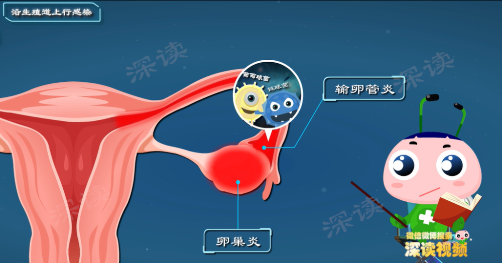 "4大事项助你防止卵巢炎，健康生活从有效管理妇科疾病开始！"