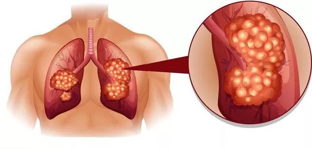 "探寻肺癌咳血背后的真相：如何判断是否威胁生命？"