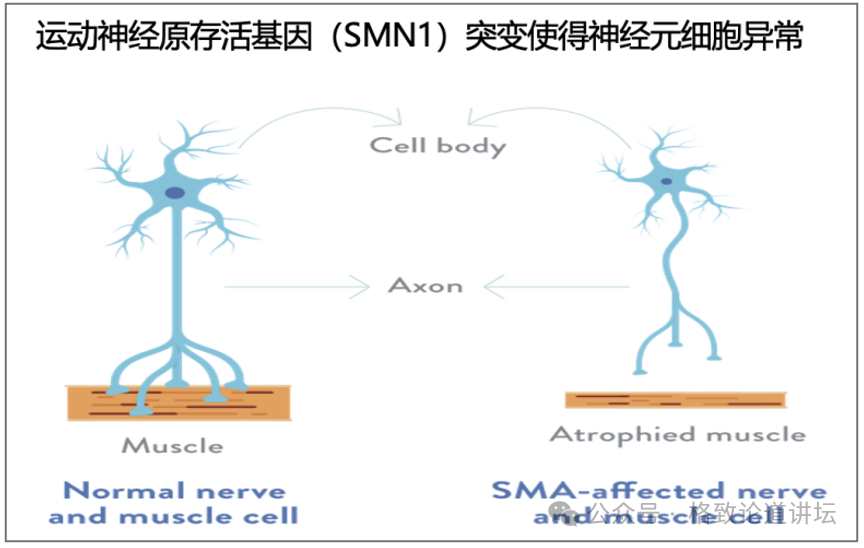 "基因疗法：一出生就能无法产生多巴胺的孩子们找到了新的快乐源泉"