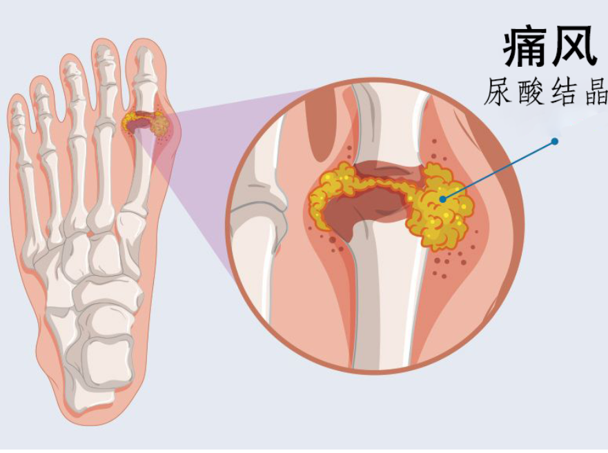 "痛风：为什么疼痛总是在你的身体里挥之不去？让这些日常护理技巧帮你远离痛风的困扰吧！"