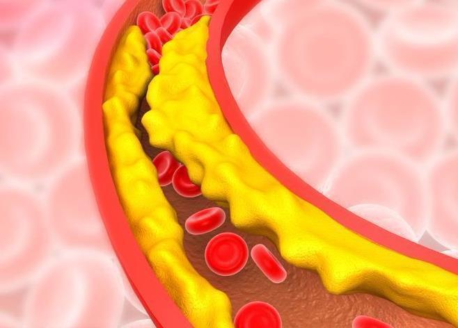 "胆固醇：分类、原因与健康管理全指南"