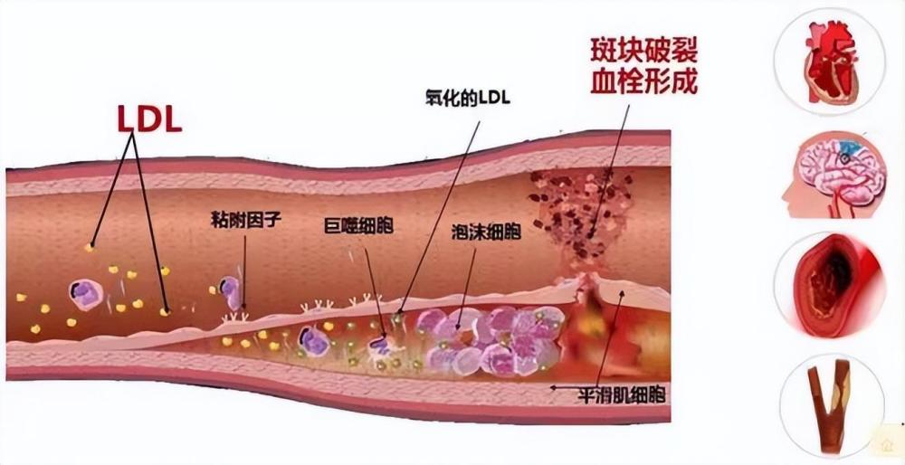 "90后熬夜刷手机引发心脏病：年轻人的心梗与老年人有何不同？"