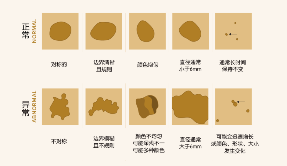 "重要提示：人人都有可能拥有的黑色痣应引起重视"