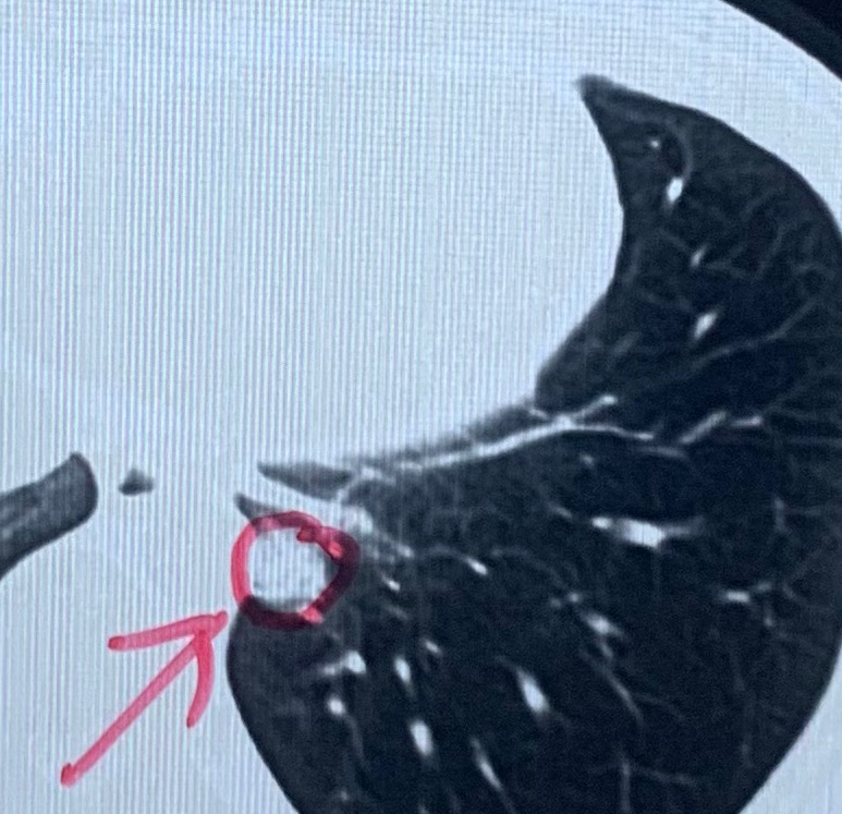 "这场考验! 这个2cm肺实性结节，差点被延误!"