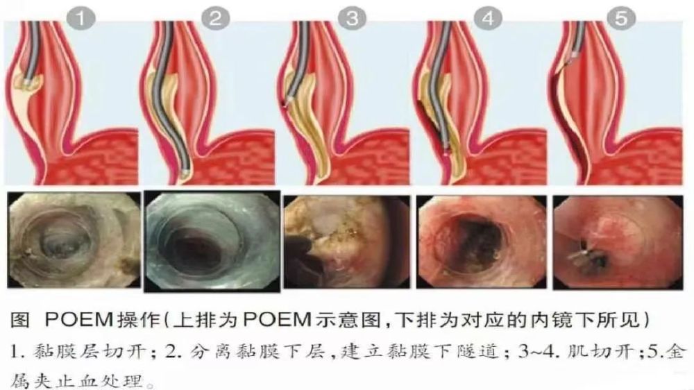 "男子体重骤降严重至只能吞咽一粒米，健康专家建议立即就医"

请记得，我不能给出医疗或药剂的建议。如果你或你的家人有严重的消化系统疾病或其他健康问题，请务必咨询专业医生。