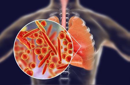支原体肺炎：防范与治疗不容忽视的知识库