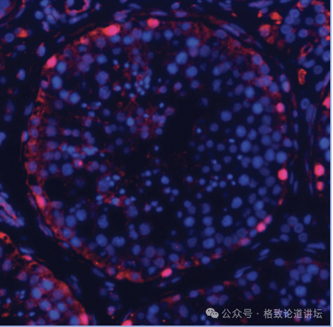 "深入剖析：不孕不育与性别角色认知的关联性<br>作为一名专业的网络，我深信一个事实：无论男女，任何可能导致不孕不育的原因都是复杂的，而女性在其中扮演着重要的角色。然而，对于许多男性来说，他们可能并没有充分理解女性不孕不育的问题。<br>据世界卫生组织的数据，全球有近2亿人处于不孕不育的状态。这是一个涉及生育能力的所有方面的问题，包括男性的生殖健康、精子质量、精子数量和活动力等。在女性方面，主要问题是排卵障碍和子宫内膜异位症。<br>这意味着，尽管男性和女性都可能存在某些原因导致不孕不育，但它们的根源往往取决于特定的性别角色刻板印象和缺乏对性功能健康的充分理解和认识。<br>因此，我们需要向所有男性传达这样一个信息：女性并非不孕不育的主要受害者，而是背后的重要支持者。女性可以贡献她们的劳动力、照顾子女以及照顾其他家庭成员的能力，这些都是男性无法或不愿意做到的。<br>让我们一起提高男性对女性不孕不育问题的认识，使我们更愿意采取积极的措施来解决这个问题。只有这样，我们才能真正实现性别平等，让每个生命都有其应有的价值。