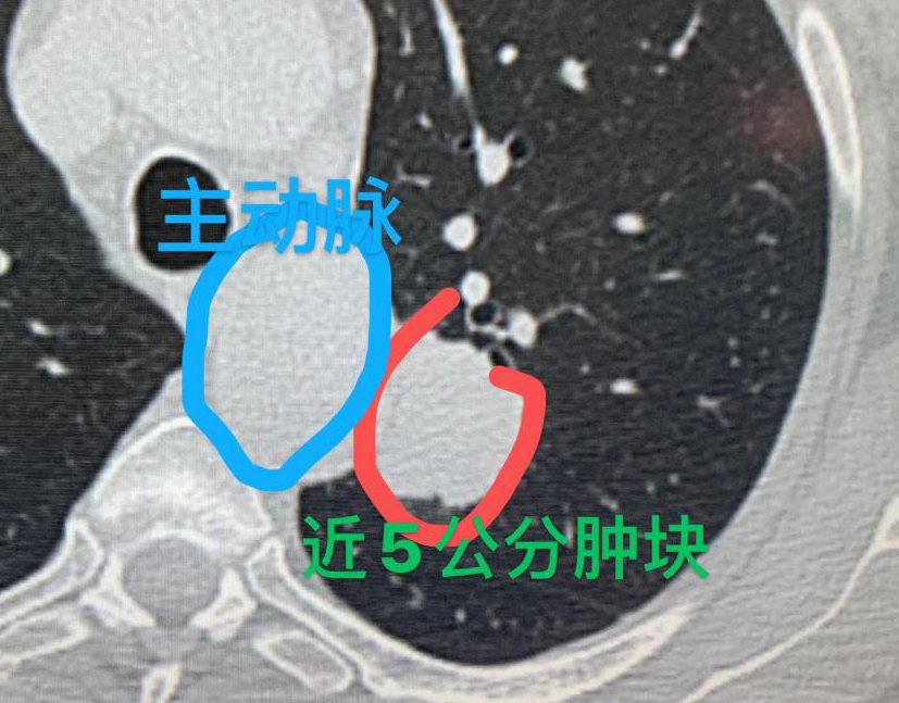 "全国癌症地图-东北三省、云南是肺癌高发区吗？让我们一起探讨与了解"