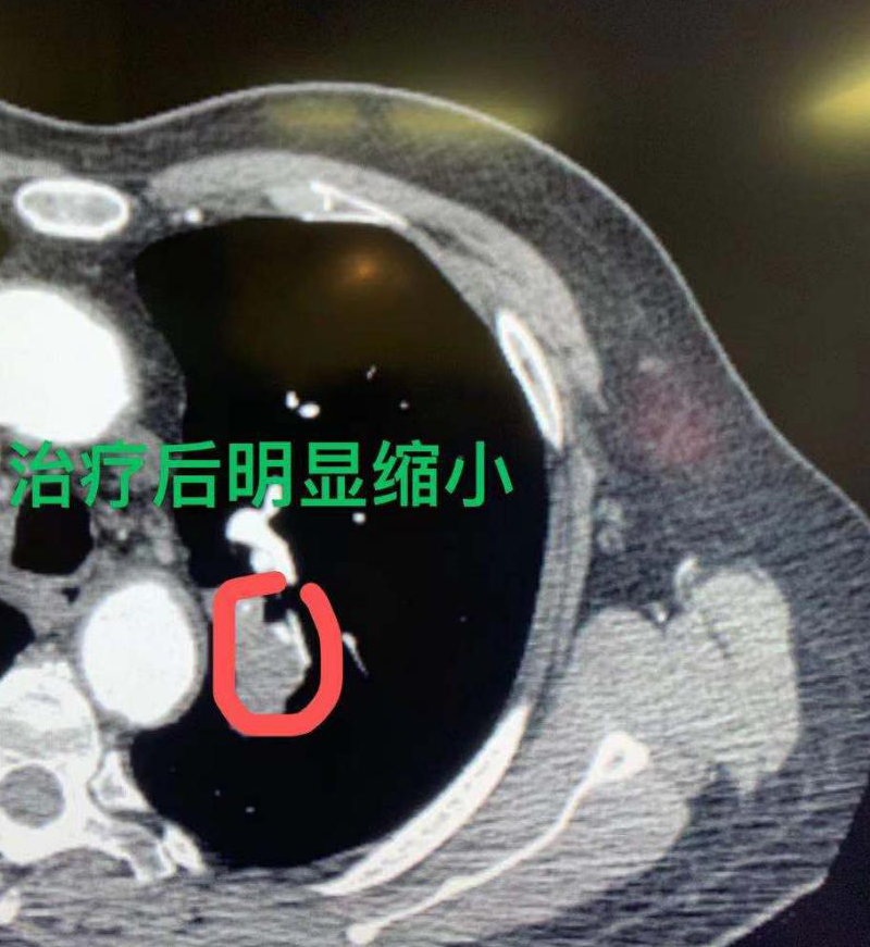 "全国癌症地图-东北三省、云南是肺癌高发区吗？让我们一起探讨与了解"