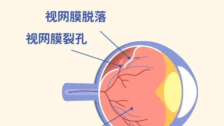 关注视力健康：掌握6个预防措施，远离视网膜脱离危机