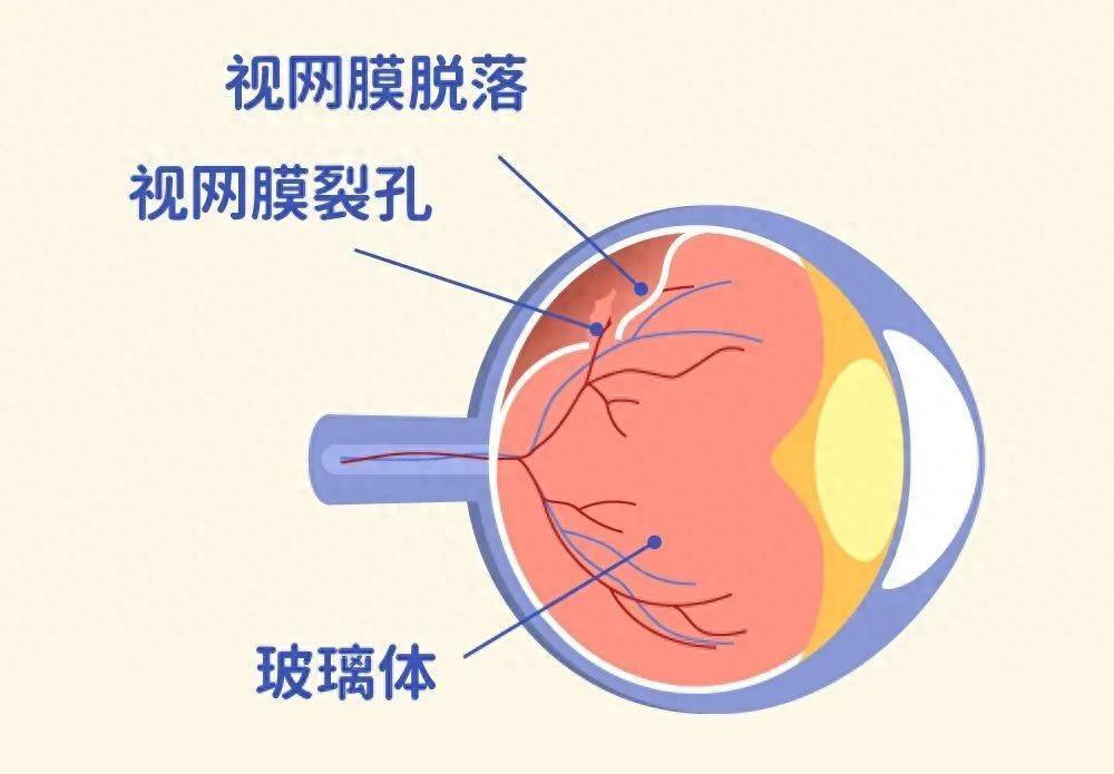 "关注视力健康：掌握6个预防措施，远离视网膜脱离危机"