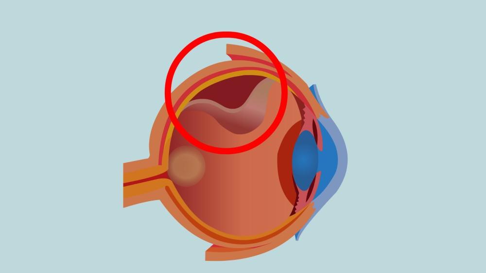 "关注视力健康：掌握6个预防措施，远离视网膜脱离危机"