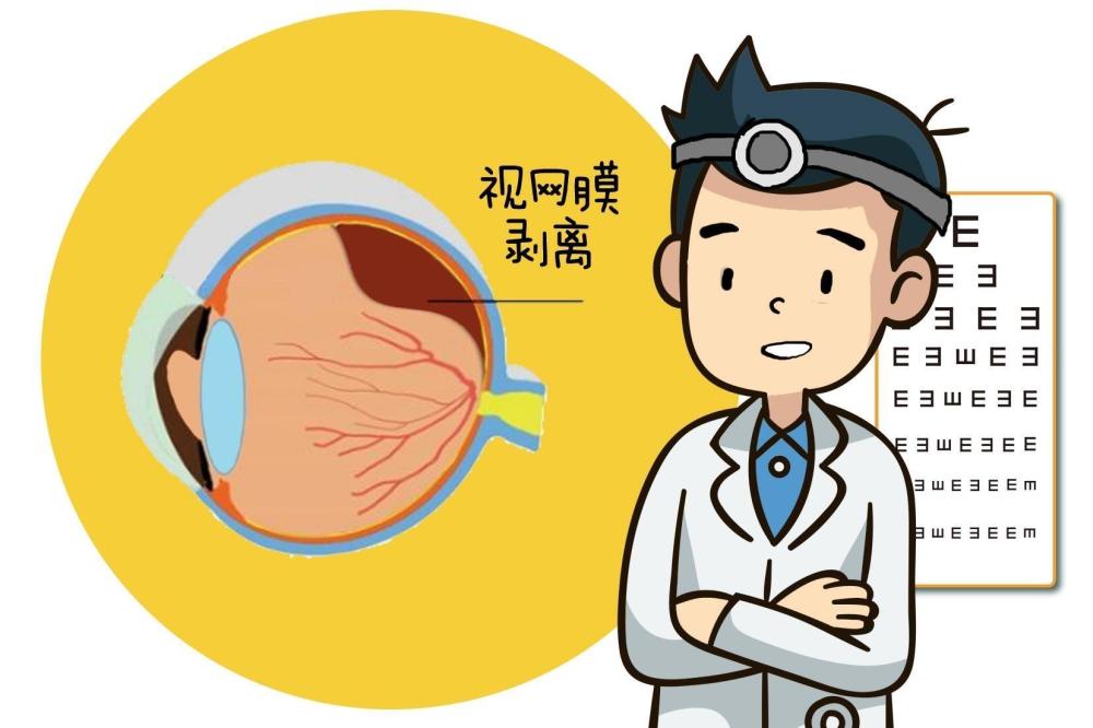 "关注视力健康：掌握6个预防措施，远离视网膜脱离危机"